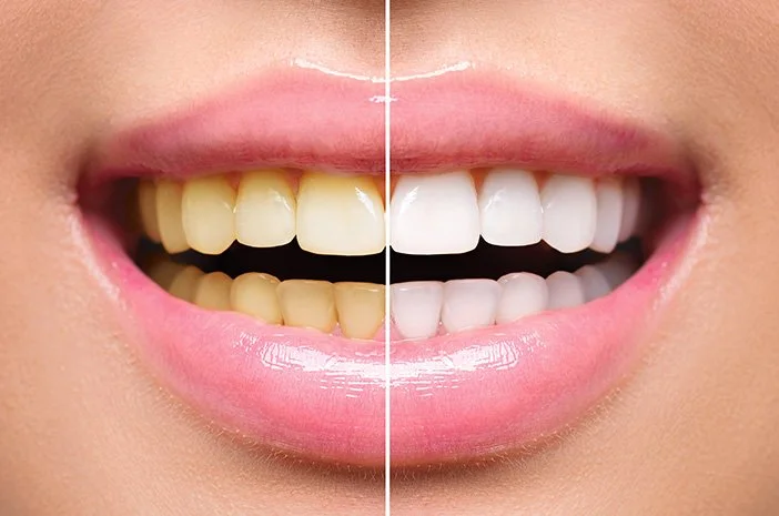 Rahasia Gigi Cerah: Berapa Sih Biaya Bleaching Gigi di Surabaya Sekarang?