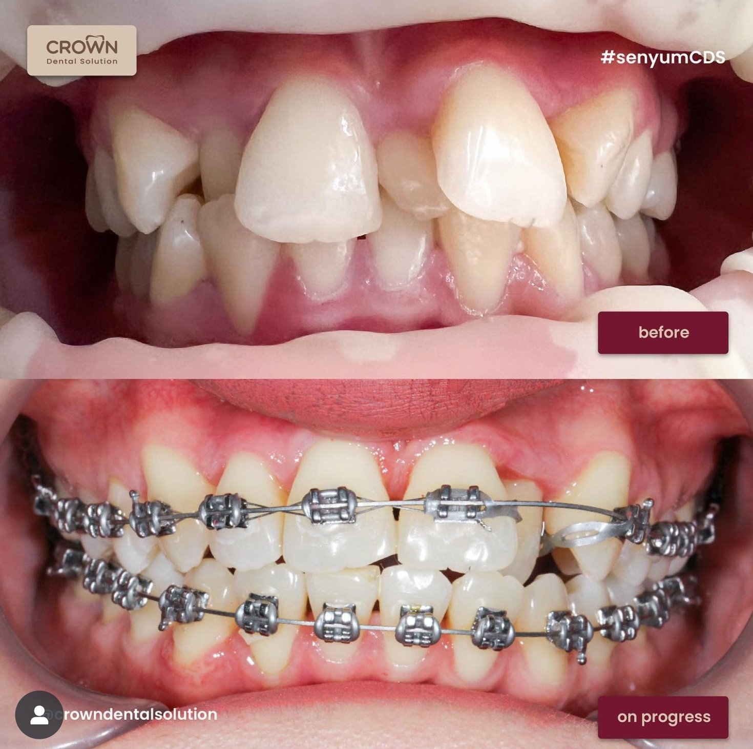 Behel atau Crown, Mana yang Lebih Sesuai untuk Senyum Kamu?