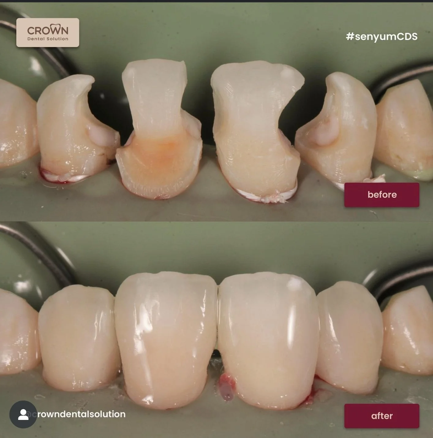 Behel atau Crown, Mana yang Lebih Sesuai untuk Senyum Kamu?