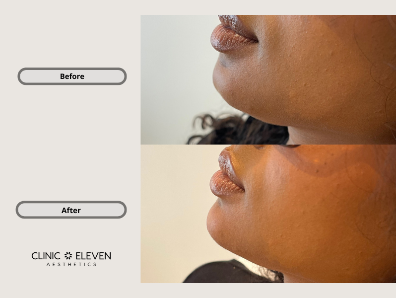 Side-by-side comparison of a woman's chin and lips before and after aesthetic treatment, showing improved skin smoothness and contour. The clinic's logo, 'Clinic Eleven Aesthetics,' is at the bottom.
