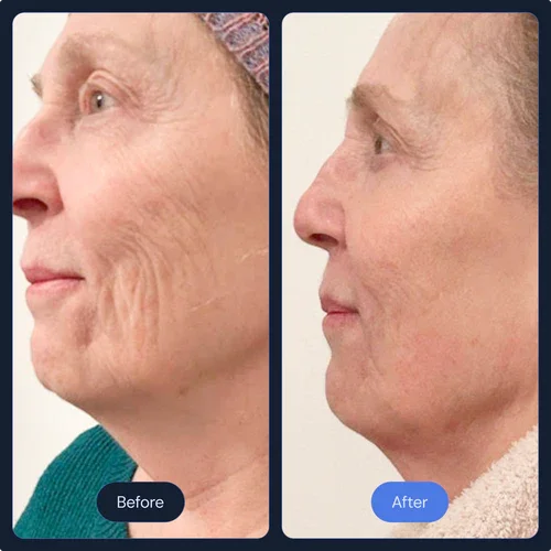 Before and After Frotox cryo treatment