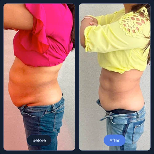 before and after cryotherapy