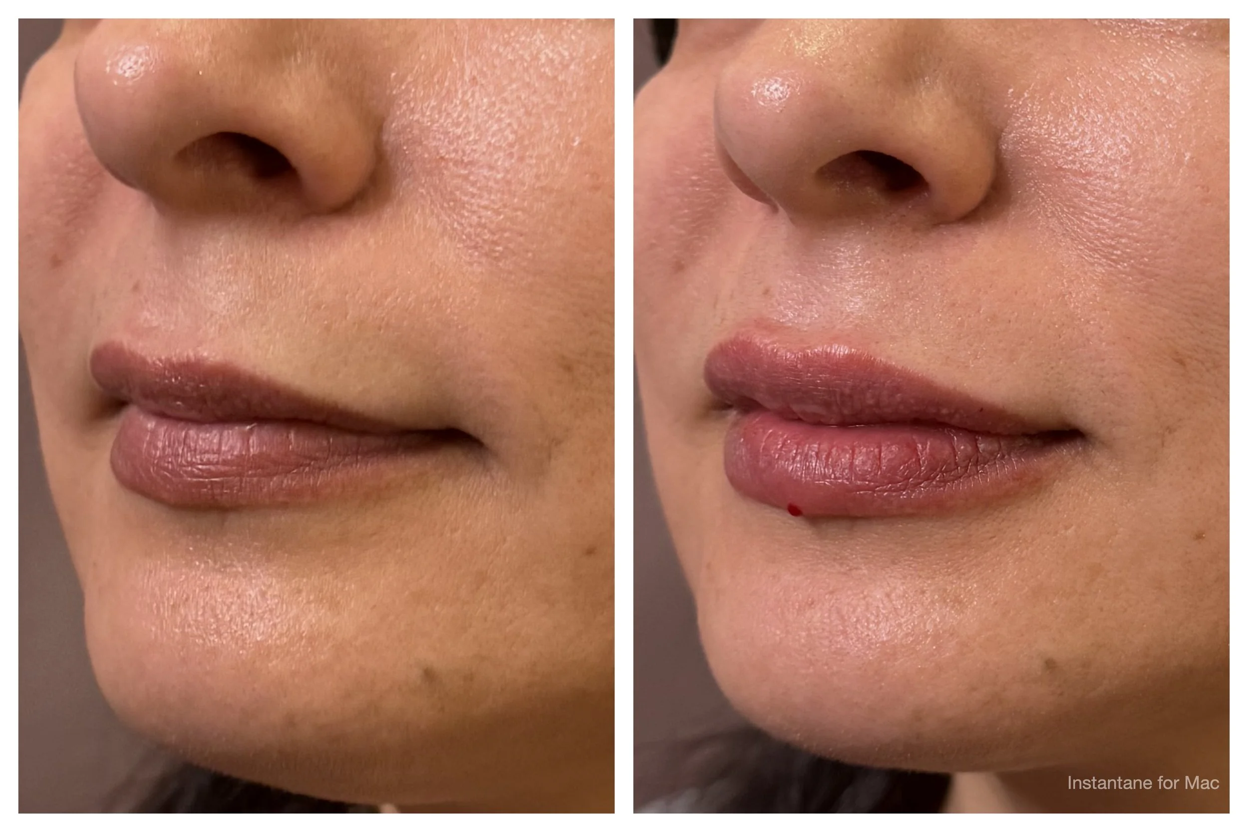 Lips half- subtle plump.jpeg