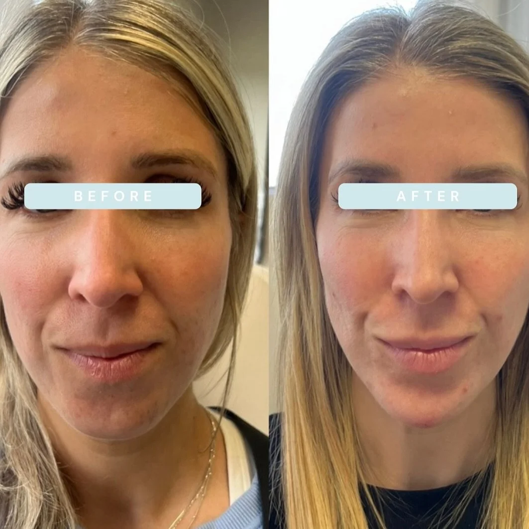 Still you, just refreshed 💉

The goal: a tailored treatment plan, multiple modalities, subtle enhancements

Photos taken two years apart
- regular tox treatments every 3 months 
- 3 sessions of microneedling, one PRF add on
- 2ml of chin filler (ove