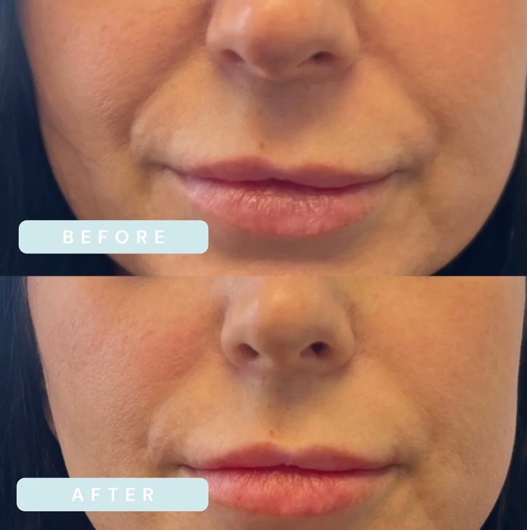 Bye bye smile lines 👋🏻 

Treatment details: 1 full syringe of filler divided between piriform fossa 

#filler #nasolabialfiller #smilelines #dermalfiller #smilelinefiller