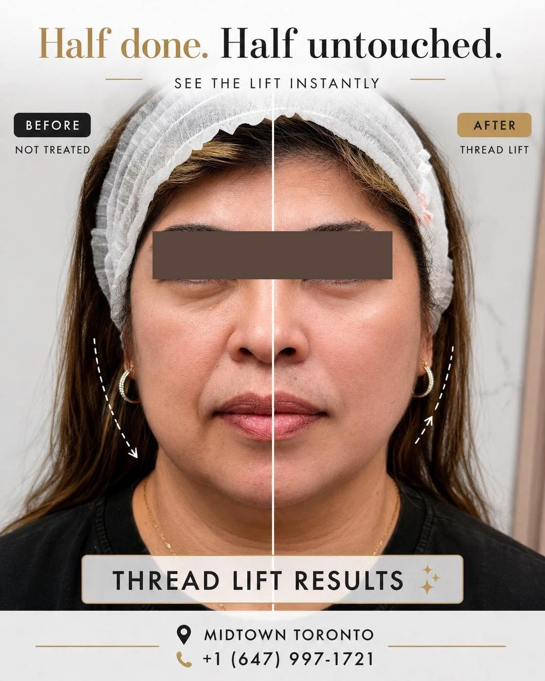 Half done&hellip; imagine the full result. ✨

Thread Lift gives you a visible lift instantly &mdash; without surgery, without waiting.

✔️ Defined jawline
✔️ Lifted cheeks
✔️ Natural, refreshed look
✔️ Minimal downtime

Real results. Real confidence.
