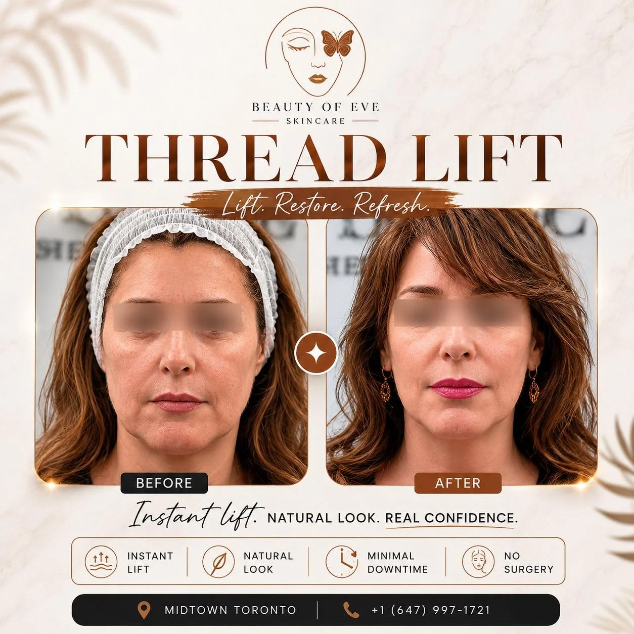 Not just a lift&hellip; it&rsquo;s a transformation. ✨

Thread Lift gives you a naturally lifted, more defined look &mdash; without surgery or downtime.

✔️ Instant visible lift
✔️ Natural, subtle results
✔️ No cuts. No long recovery
✔️ Confidence yo