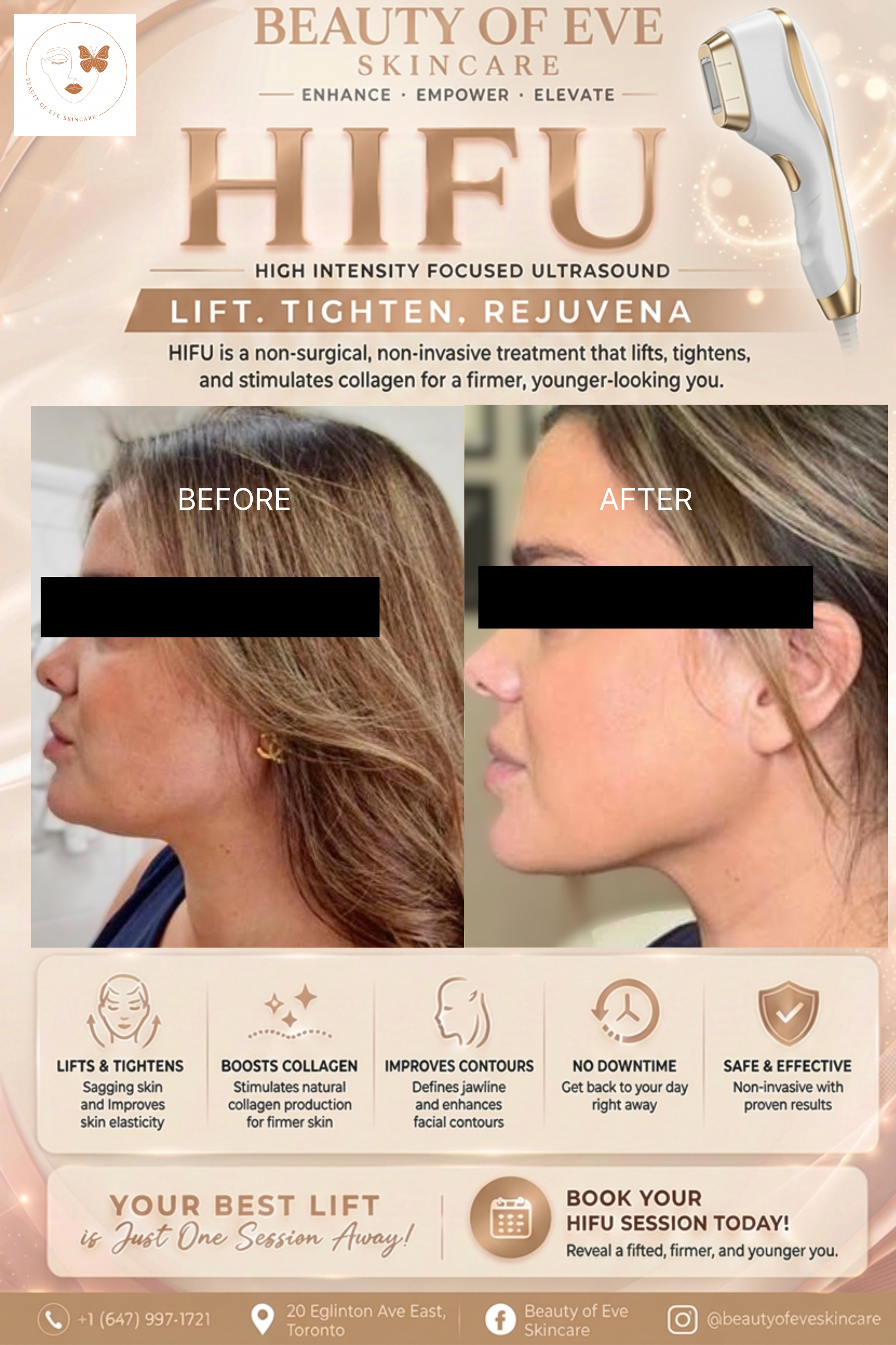 HIFU Non-Surgical Face Lift 🔥