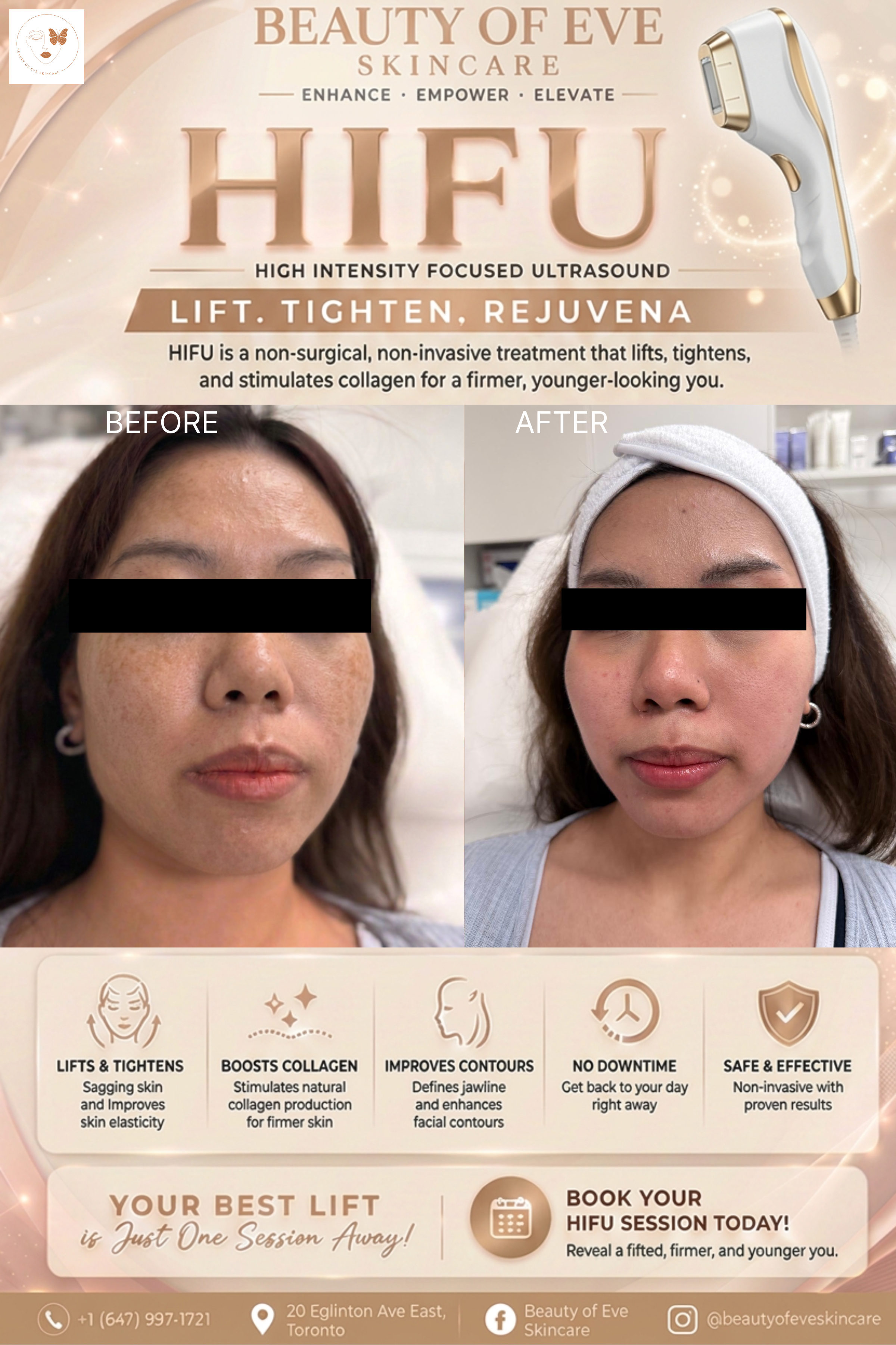 HIFU Treatment – Non-Surgical Face Lift 