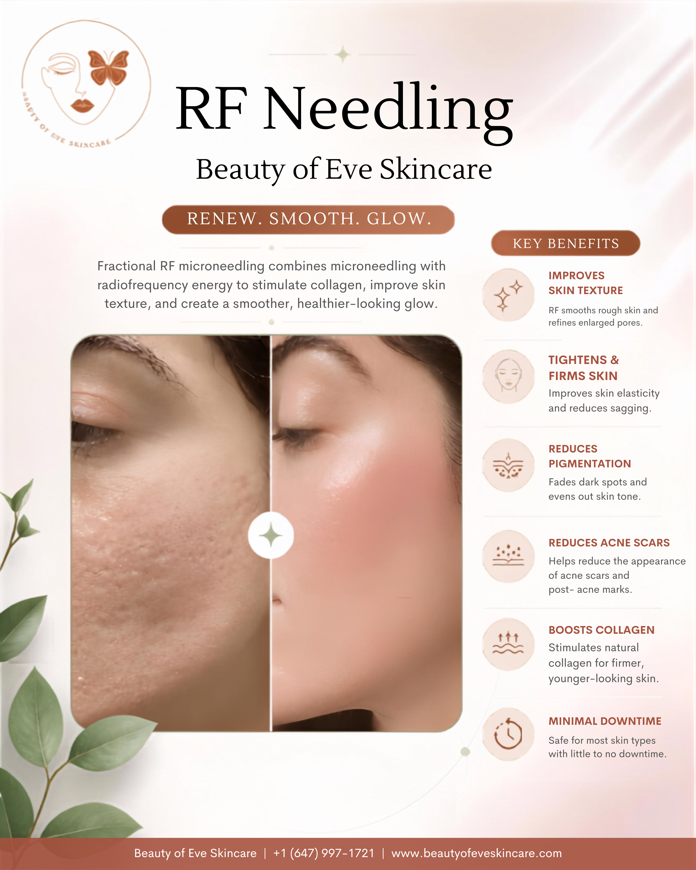 RF Needling