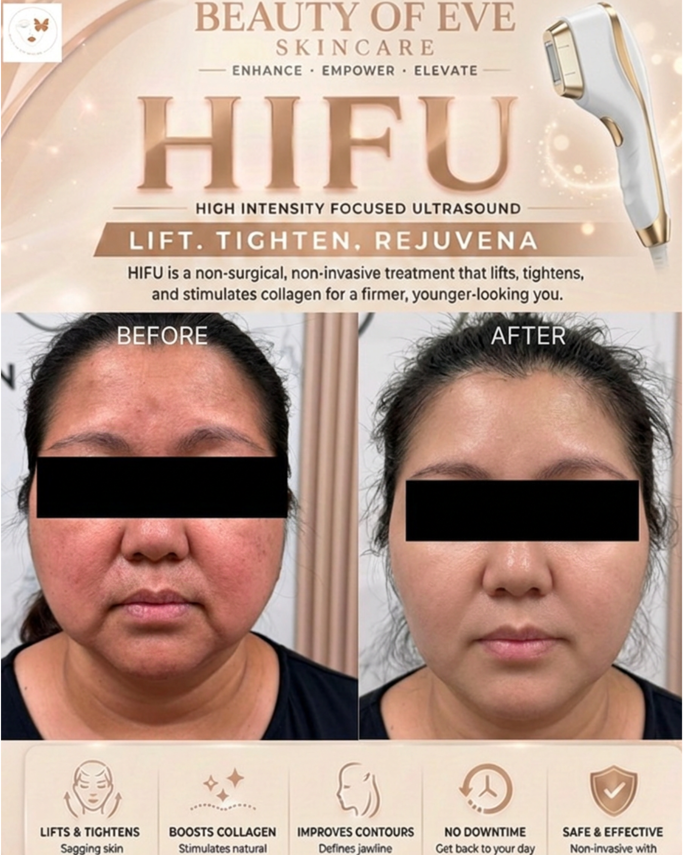 HIFU – results Non-Surgical Facelift ✨