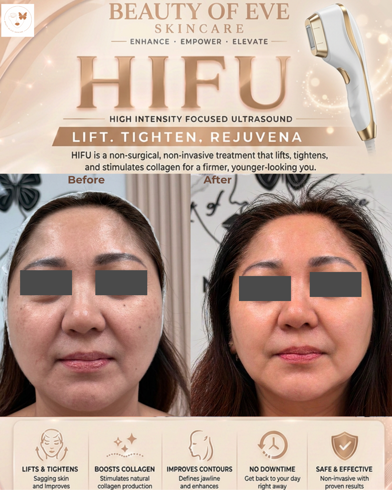 HIFU Treatment – Non-Surgical Face Lift 🔥