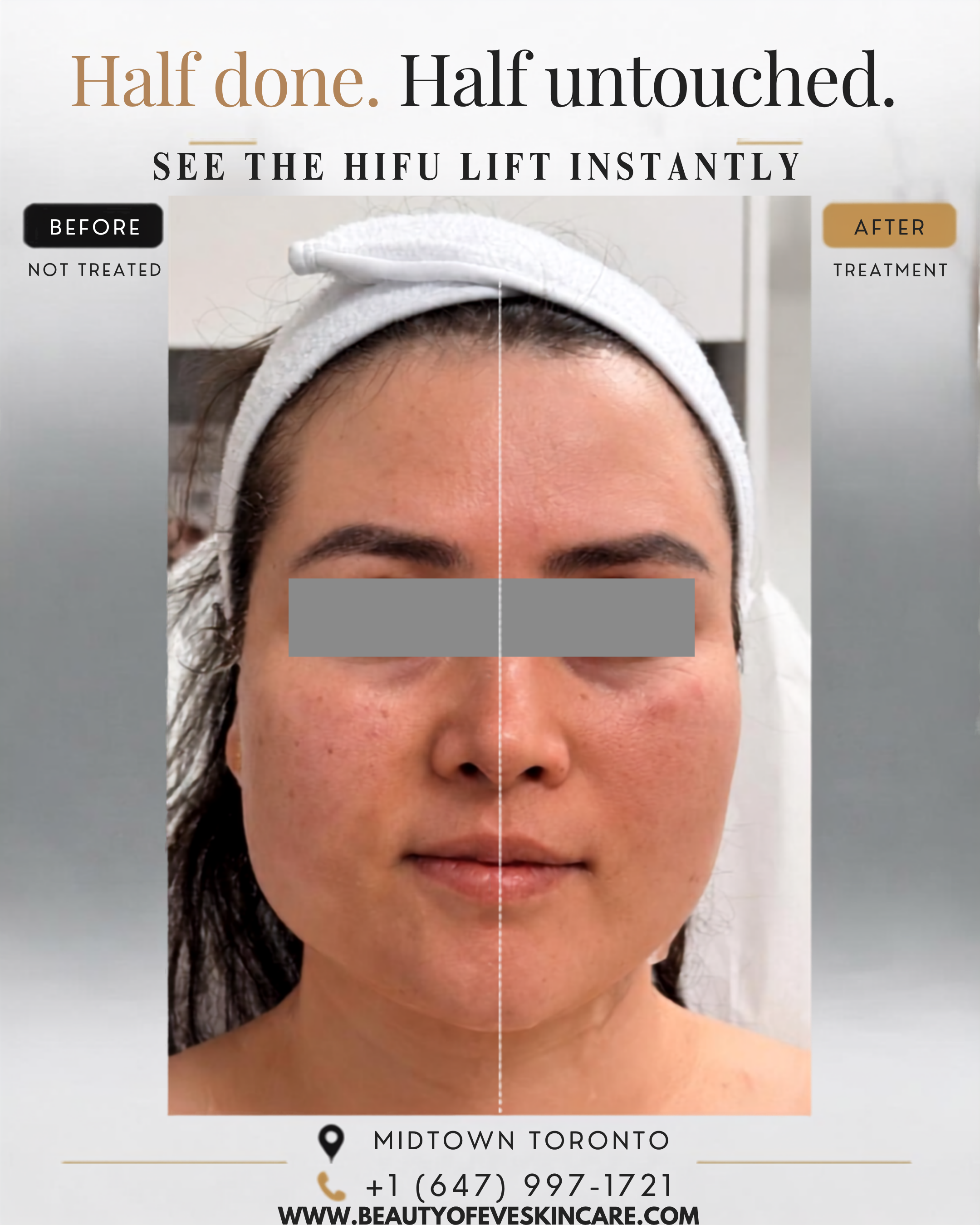 September HIFU Deals Are Live! 