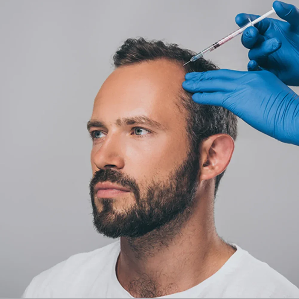 PRP hair treatment on the scalp