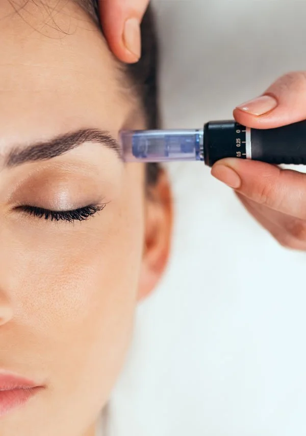 RF microneedling skin treatment