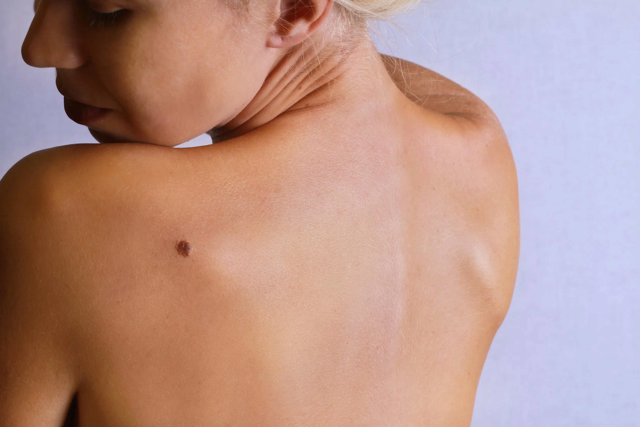 Signs of Melanoma: What You Should Know