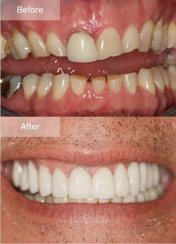 Full Mouth - Gallery - Image - 03.jpg