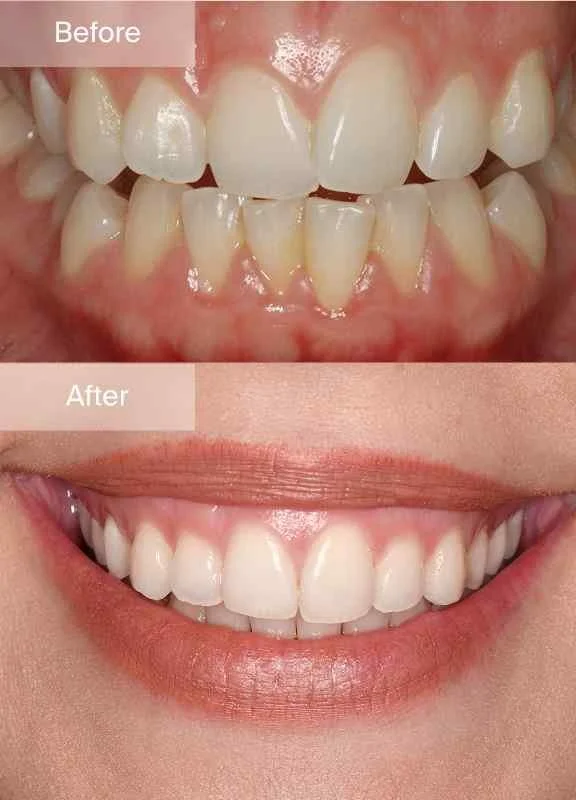 Before and after comparison of an Invisalign patient
