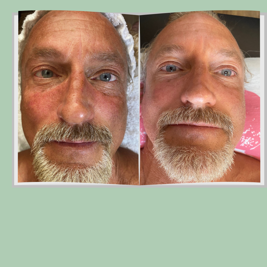 Michael K facial 1.png