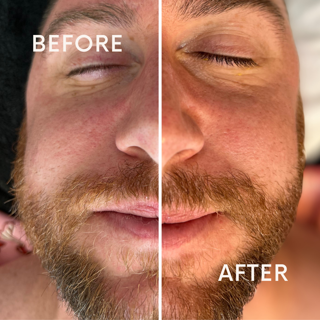 chemical peel before and after. facial before and after, chemical peels, facials available at The Cat House. best facials salt lake city, best chemical peels salt lake city, customized facial, facials salt lake city, chemical peels salt lake city