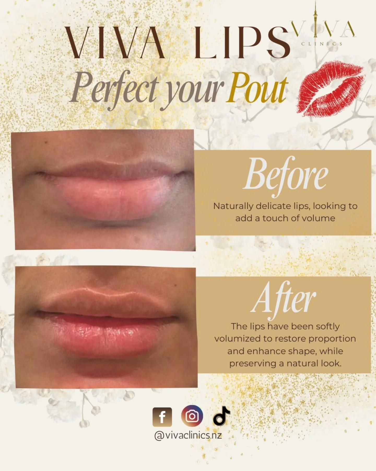 💋 Viva Lips, Real People. Real Results. 💋
See how a touch of volume can create a softer, fuller, more confident smile?
Enhance your natural beauty with our expertly crafted lip fillers, starting from just $450. Subtle or statement. We tailor every