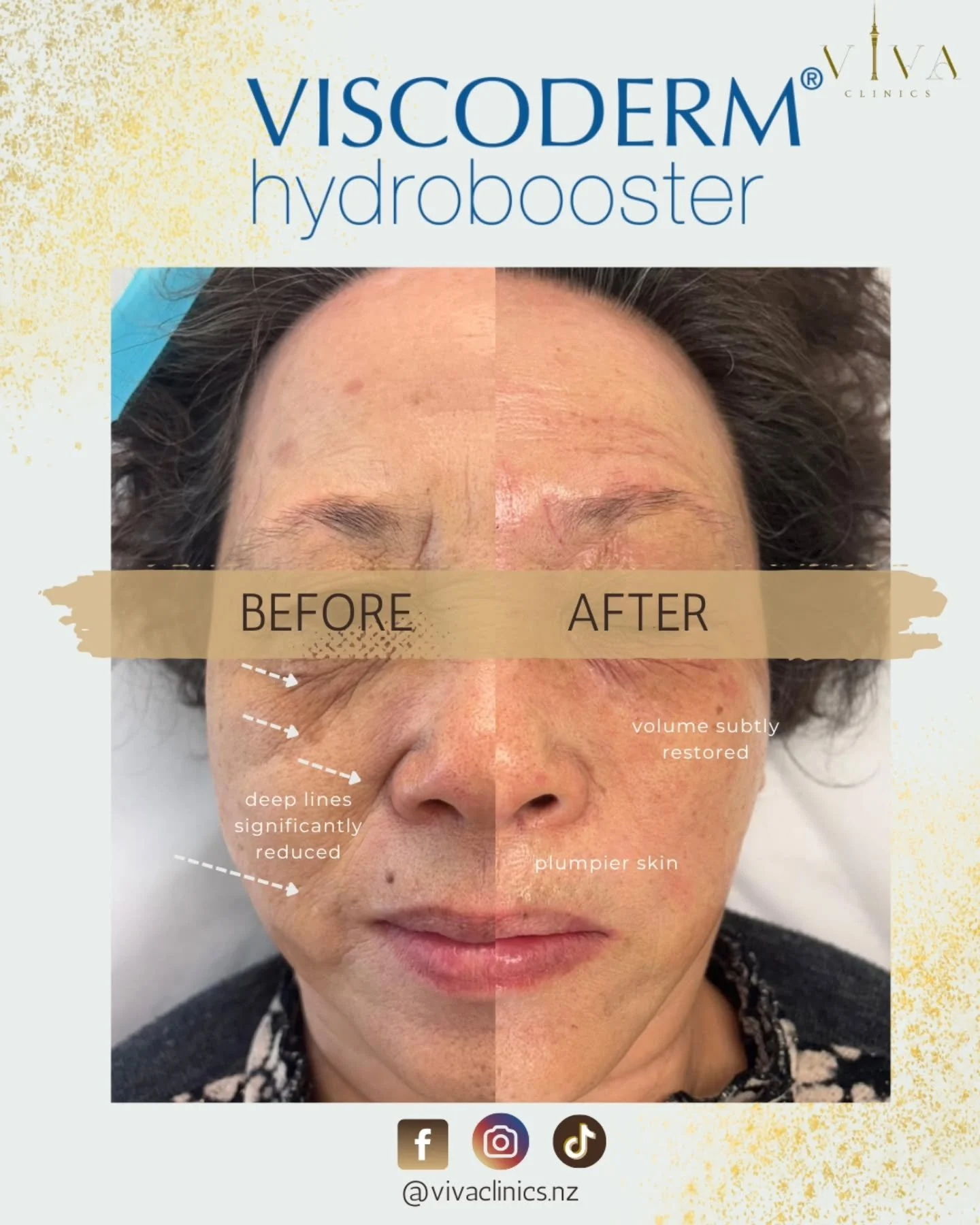 𝗖𝗹𝗶𝗲𝗻𝘁 𝗦𝗽𝗼𝘁𝗹𝗶𝗴𝗵𝘁: 𝗩𝗶𝘀𝗰𝗼𝗱𝗲𝗿𝗺
Real results with Viscoderm Hydrobooster, designed to restore hydration, smooth deep lines, and bring back natural radiance from within.
Notice the transformation:
• Deep lines visibly soften