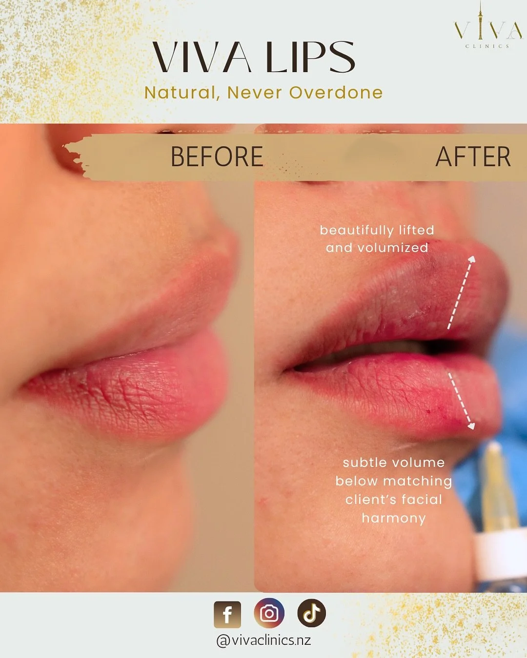 Plump, smooth, and beautifully defined. Experience Viva Lips and enjoy 10% off before the month ends!
📍 Visit us at 1280 Dominion Road, Auckland, New Zealand
📞 09 600 2551
Follow us for updates, special offers, and expert care tips.
#AucklandCli