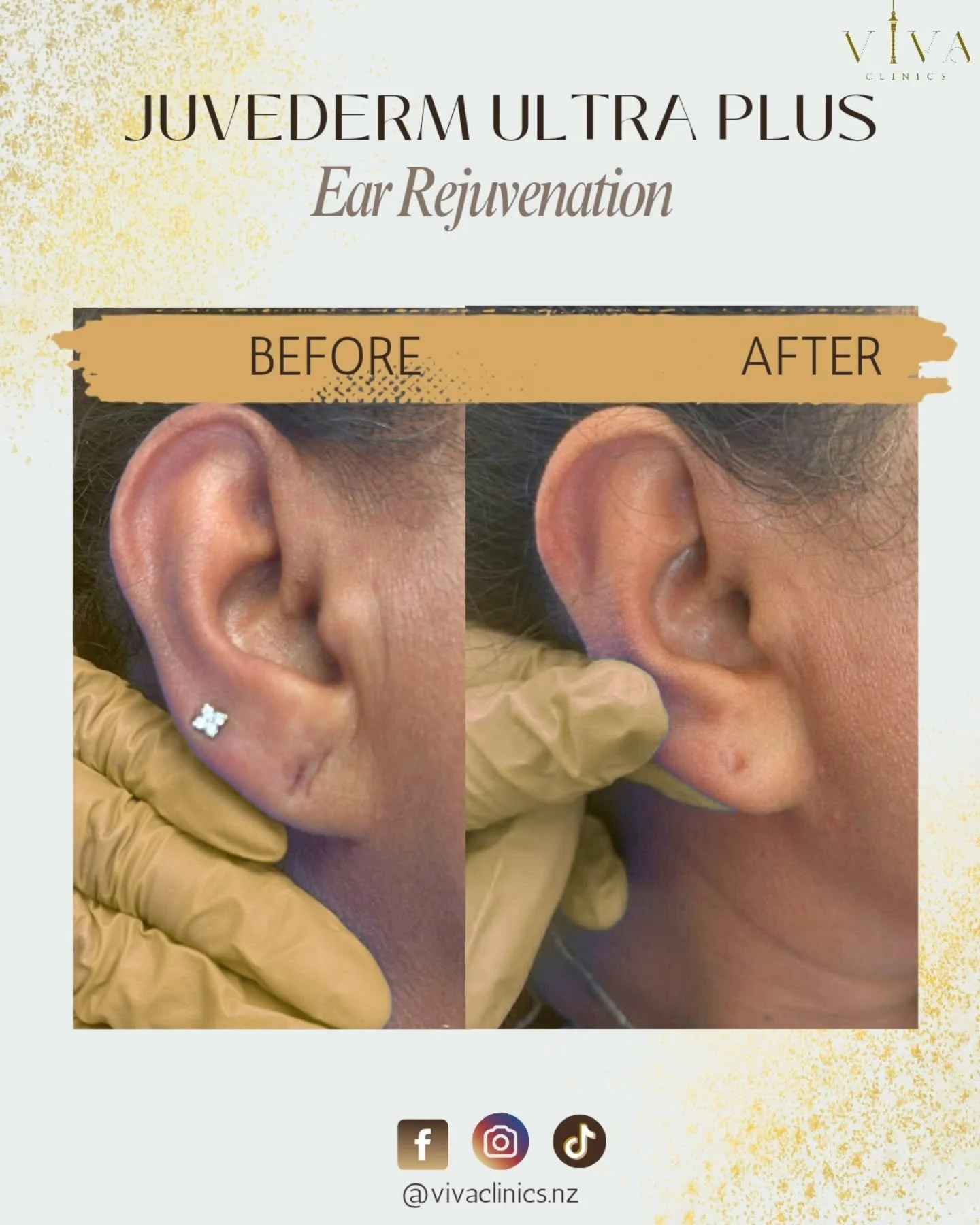 𝙀𝙖𝙧 𝙍𝙚𝙟𝙪𝙫𝙚𝙣𝙖𝙩𝙞𝙤𝙣 𝙗𝙮 𝙅𝙪𝙫&eacute;𝙙𝙚𝙧𝙢&reg; 𝙐𝙡𝙩𝙧𝙖 𝙋𝙡𝙪𝙨

A subtle enhancement that restores balance, 
Our ear rejuvenation treatment helps refresh and support the earlobe area, with full results developing at 4 weeks.
Per