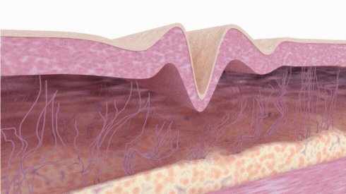 We offer advanced microneedling, RF collagen induction, and treatments for post-acne scarring or stretch marks—perfect for renewing tired or textured skin.