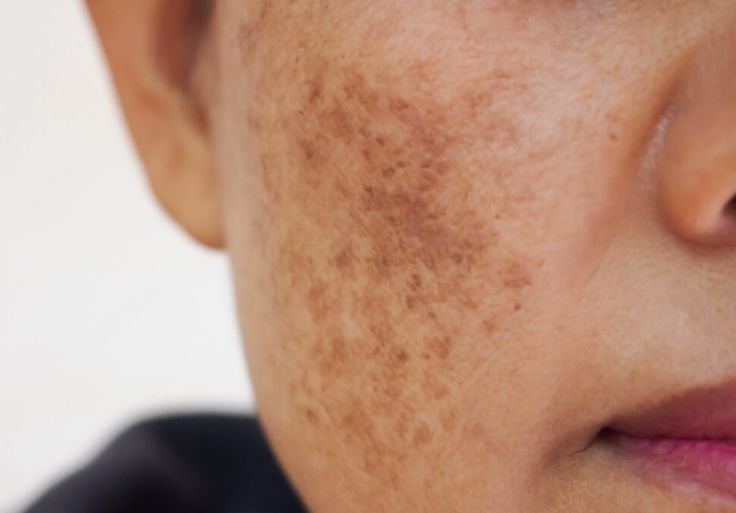 melasma.jpeg