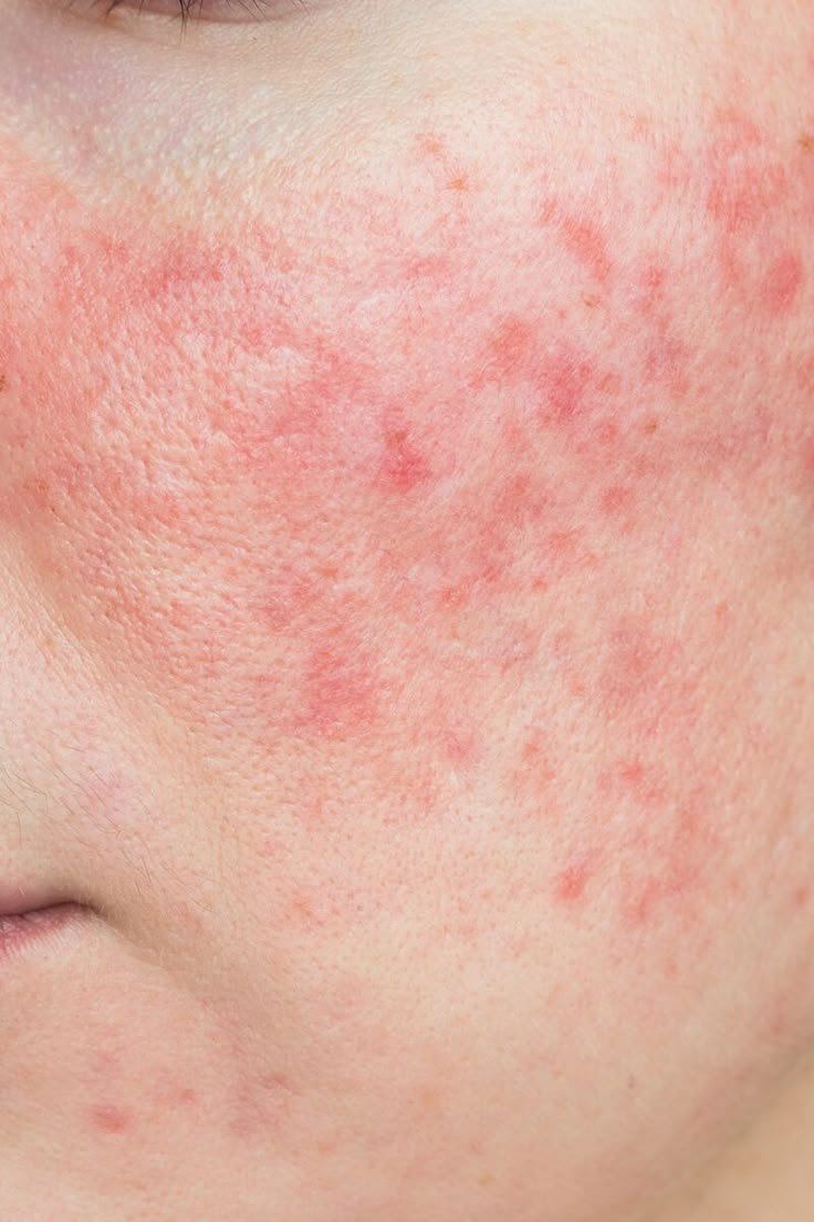 rosacea.jpeg