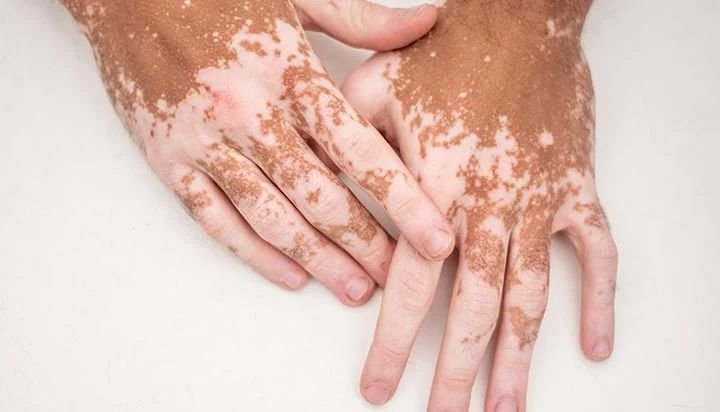 vitiligo.jpeg