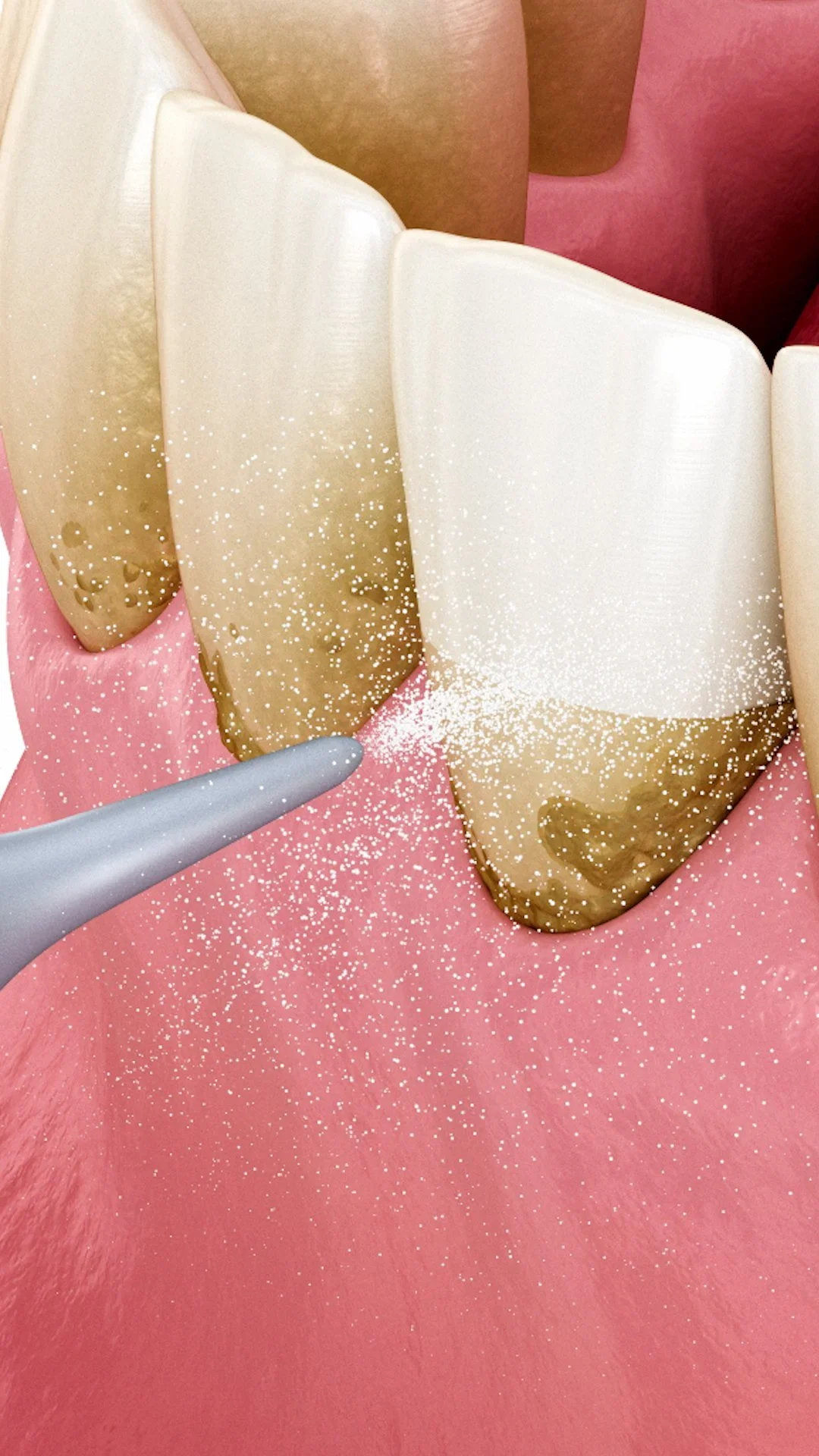 Plaque and Your Smile: What You Need to Know