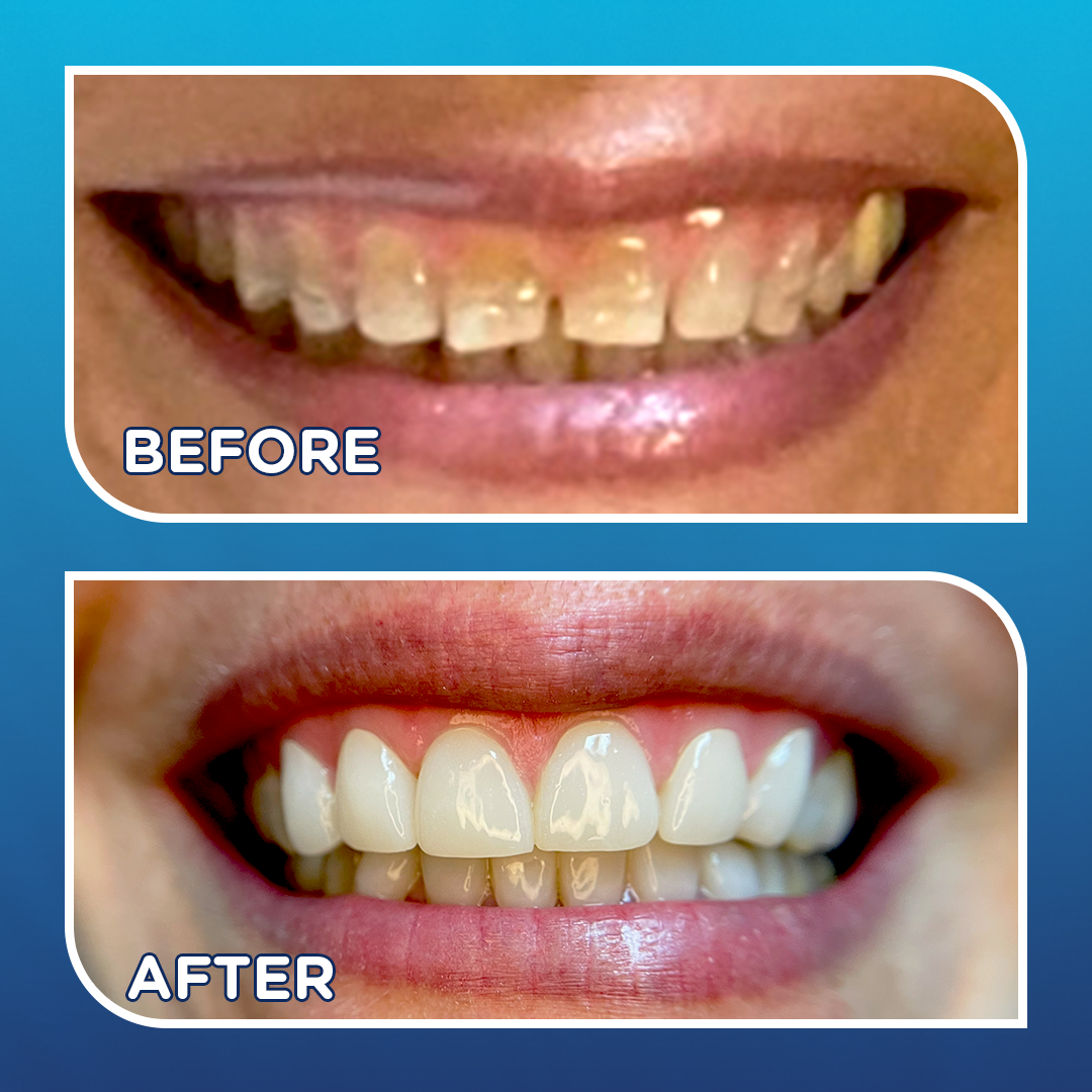 A Transformation That Speaks for Itself: Treating Tetracycline Staining with Custom Veneers