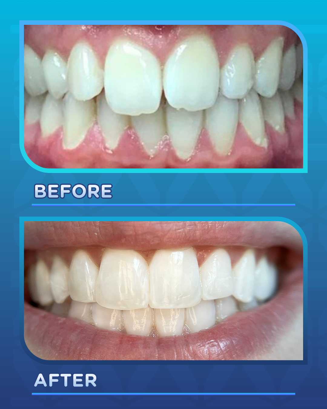 Smile Transformation Spotlight: Orthodontics + Bonding with a Natural Touch