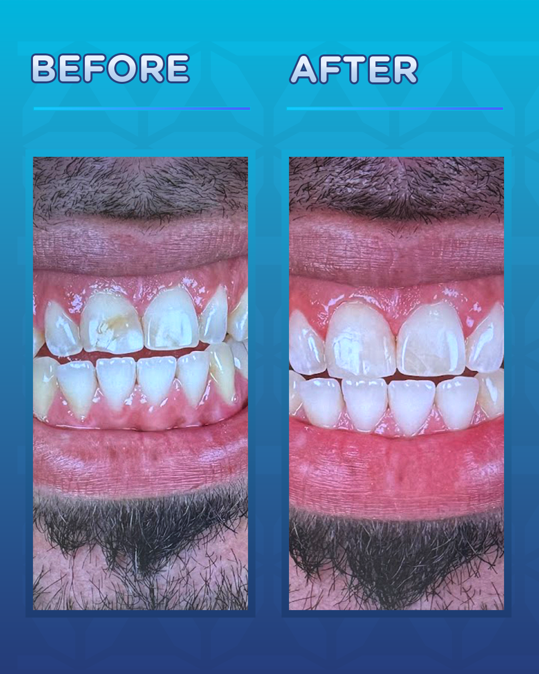 Before and after cosmetic dentistry showing a natural smile transformation with improved balance and shade matching.
