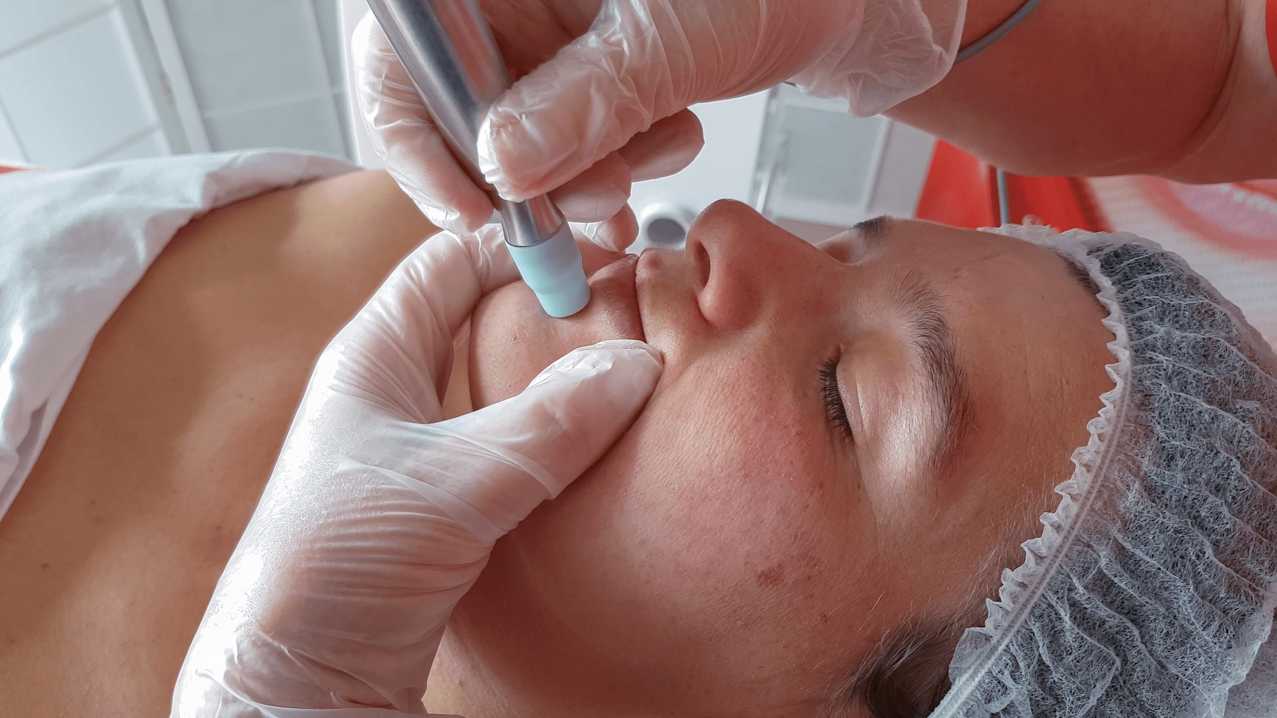 Polyabrasion Microdermabrasion 