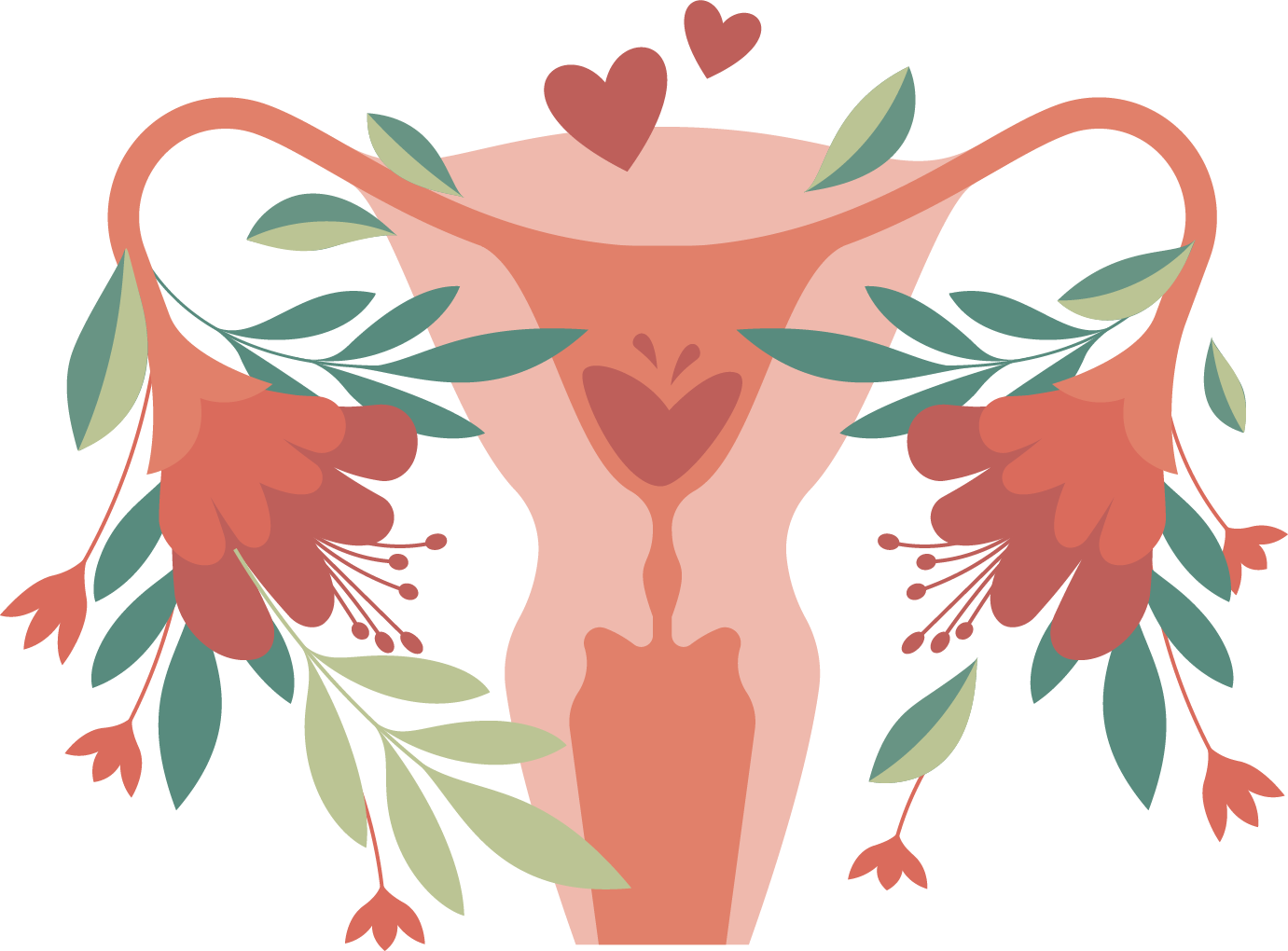 Endometriosis is a chronic inflammatory condition where tissue similar to the lining of the uterus grows outside the uterus.