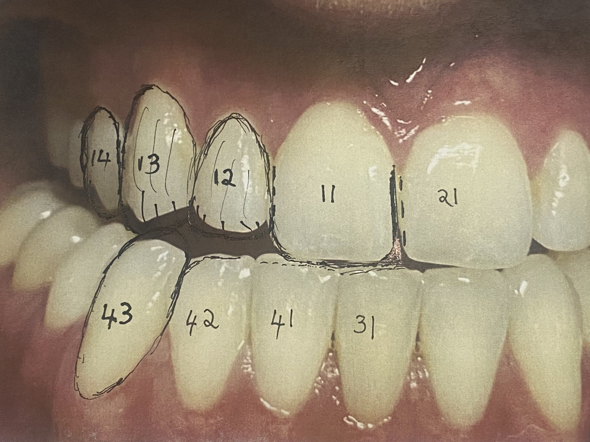 Close-up of human teeth with numbers marked on each tooth.
