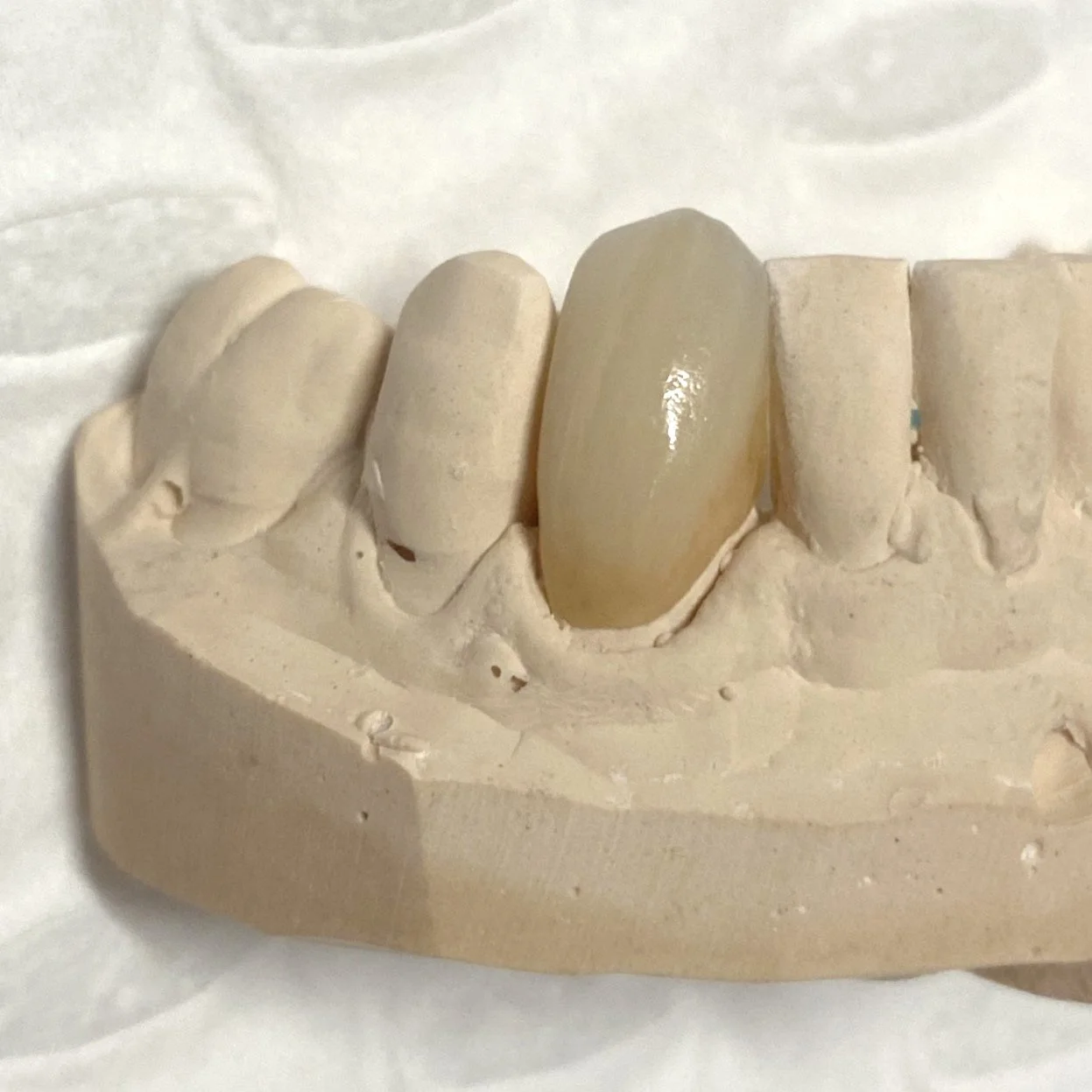 Dental plaster model with a ceramic tooth