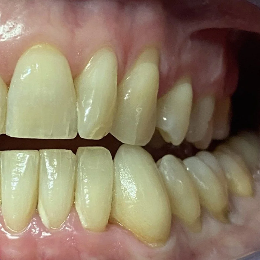 Close-up of human teeth and gums showing upper and lower incisors and canines.