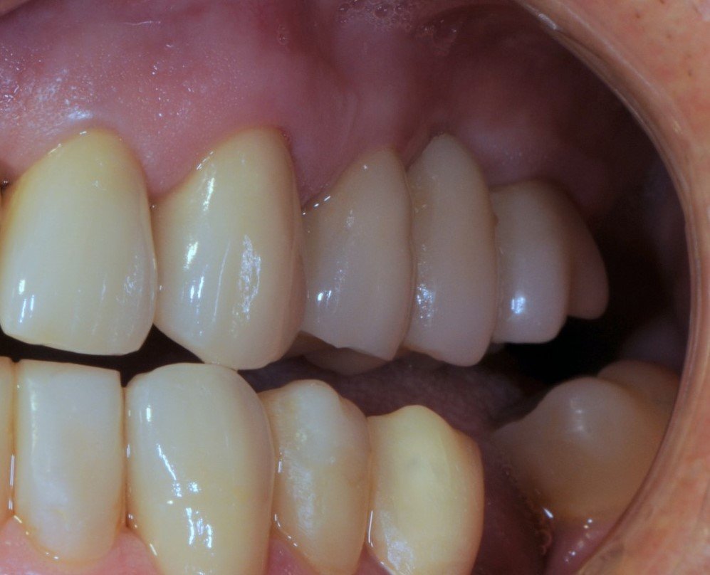 Close-up of human teeth showing upper and lower molars and gums.