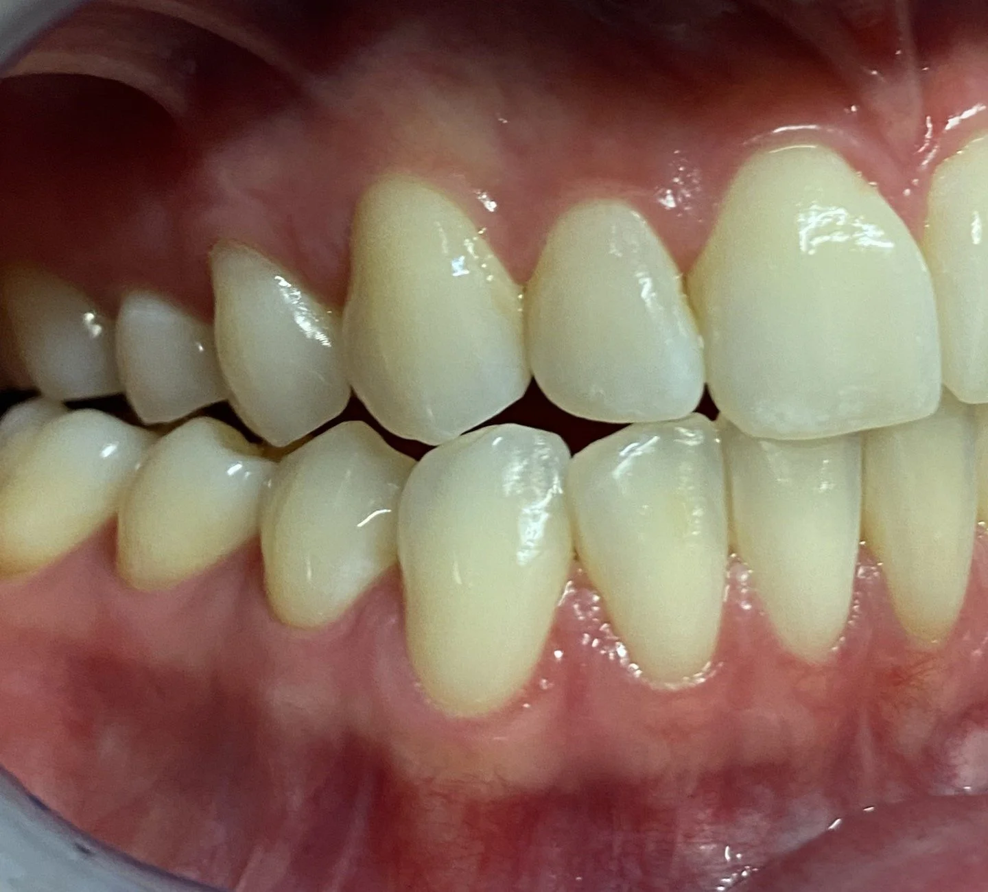 Close-up view of human teeth, focusing on the alignment and condition of the upper and lower teeth.
