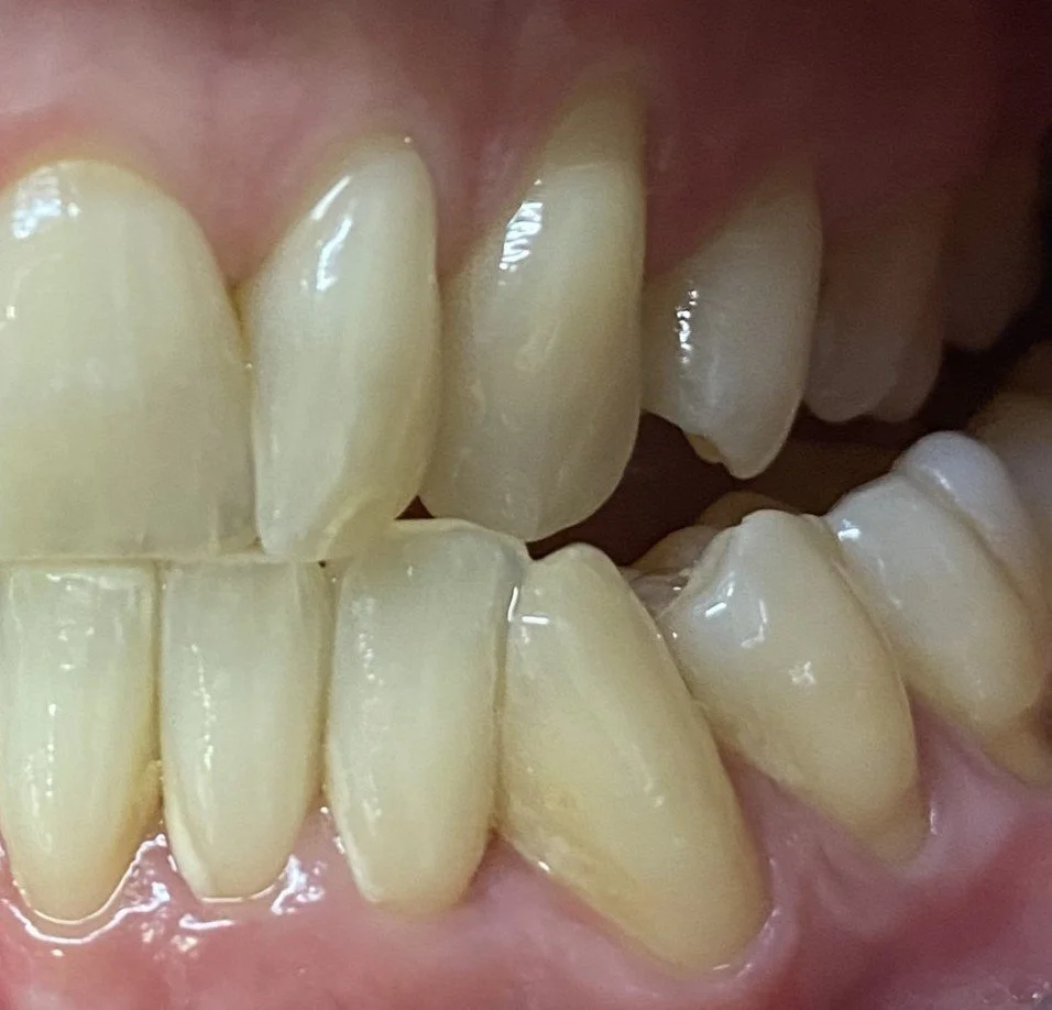 Close-up of human teeth showing bite alignment and dental health