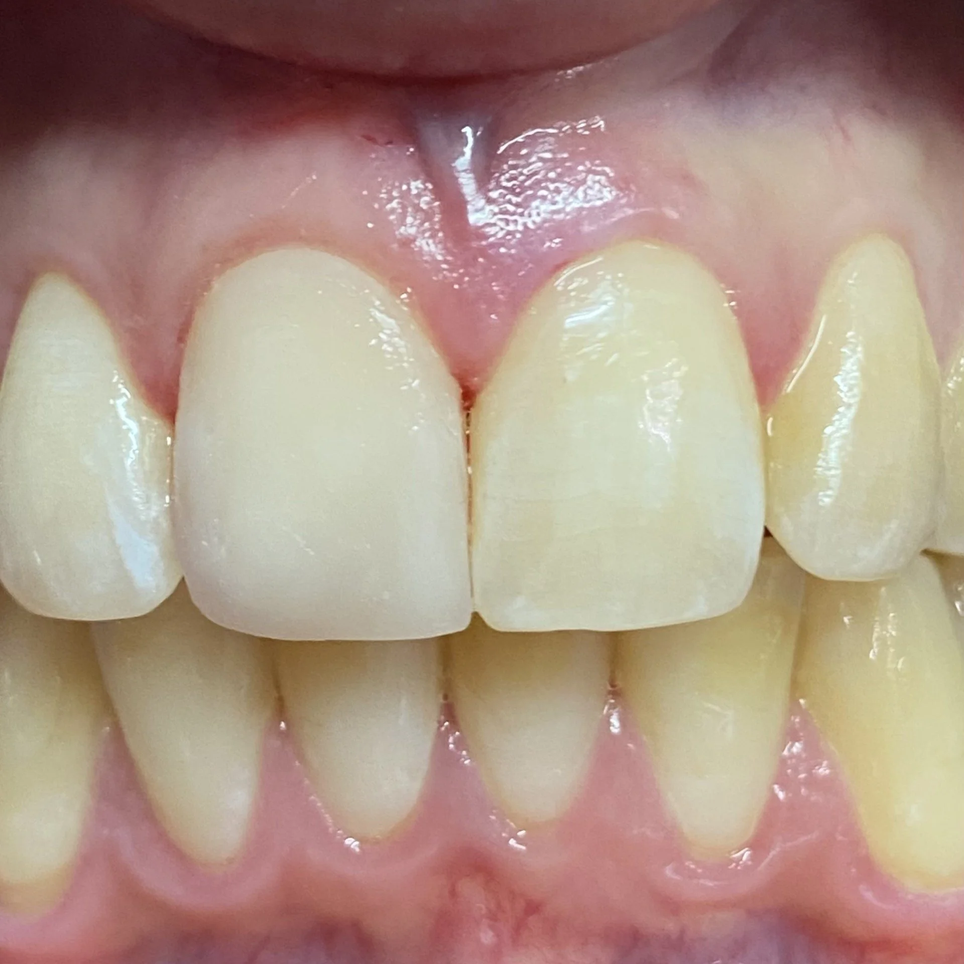 Close-up of human teeth and gums showing upper and lower front teeth.