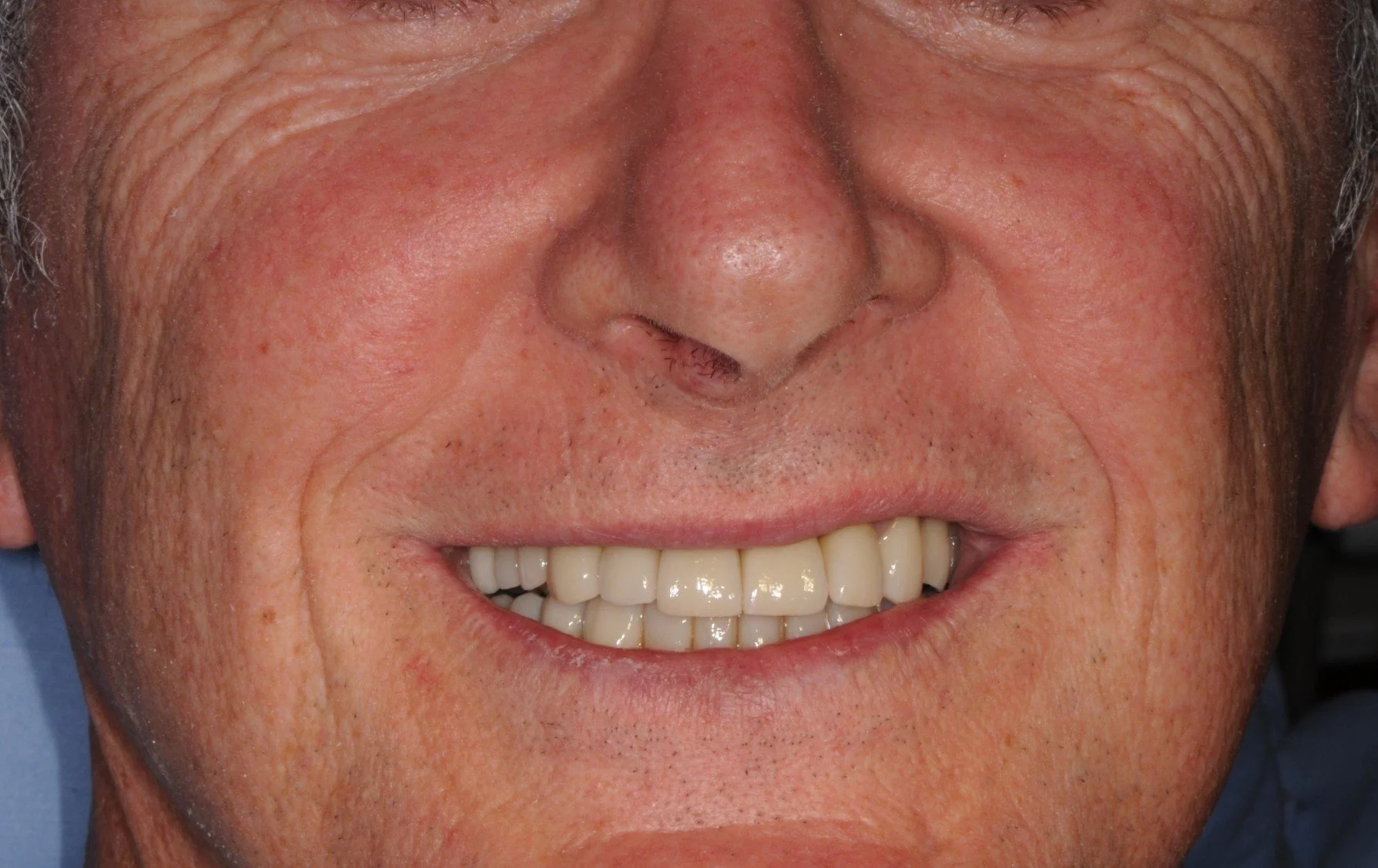 Close-up of a smiling older man showing upper teeth
