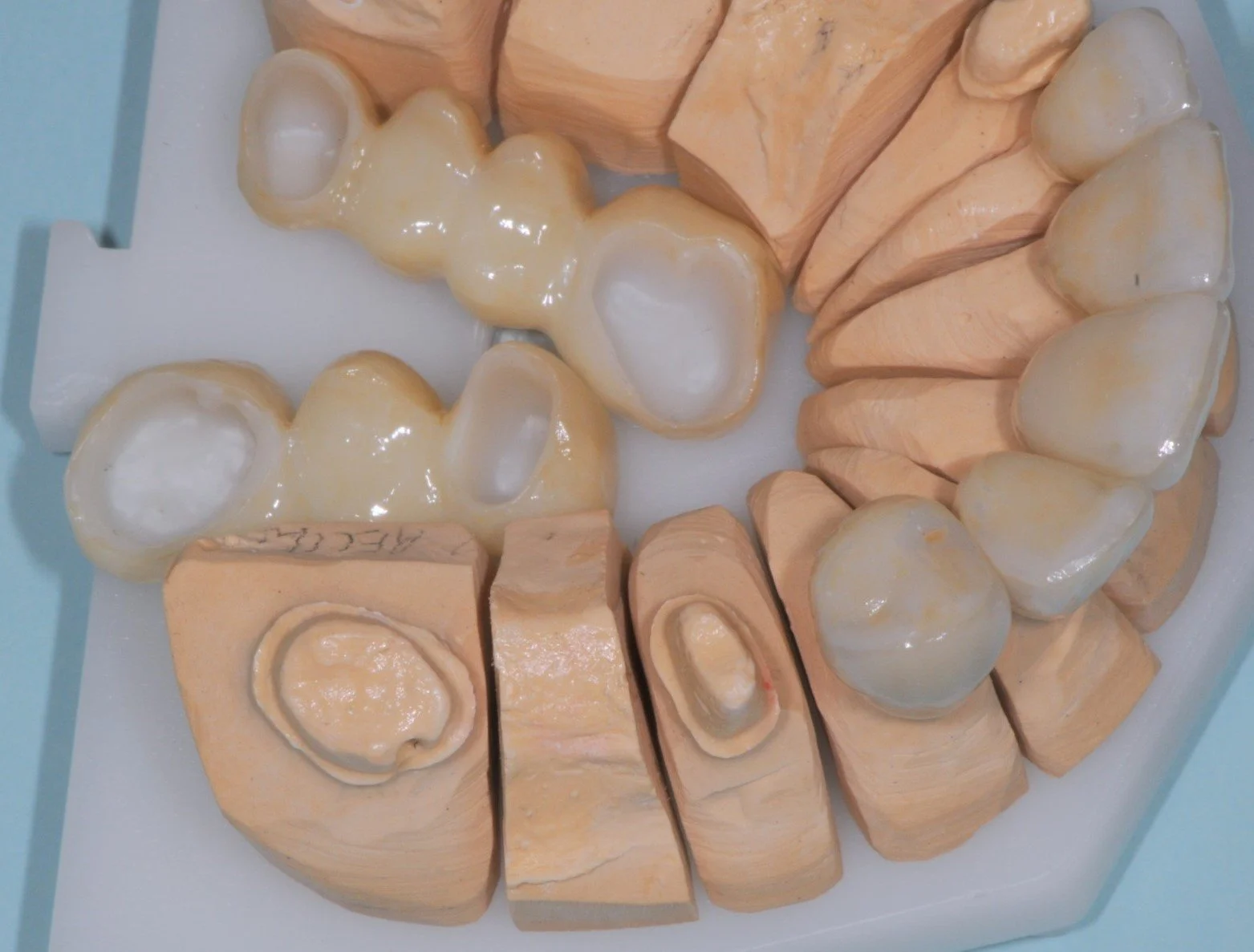 Dental plaster model showing teeth and dental crowns.