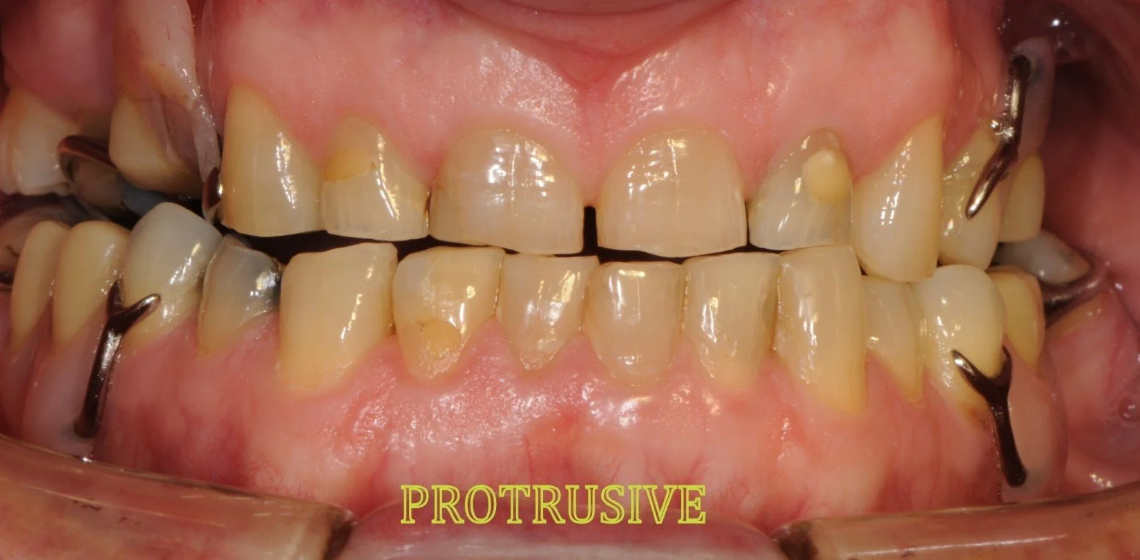 Close-up of misaligned teeth with dental crowns and metal clasps, labeled 'protrusive.'