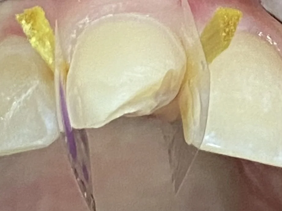 Close-up of dental restorative procedure, showing teeth with clear and yellow adhesive strips applied.