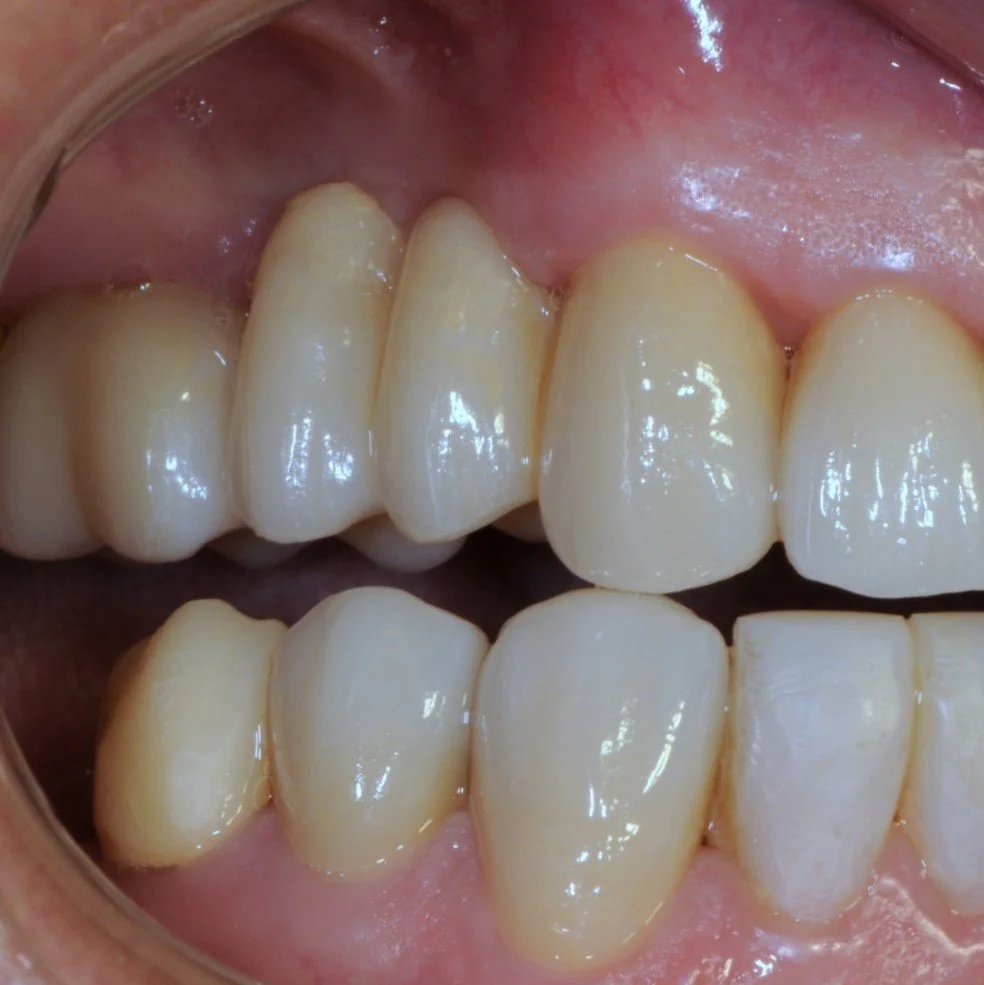 Close-up of upper and lower teeth, showing dental alignment and condition inside a mouth.
